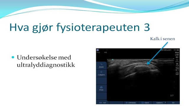 Ultralyddiagnostikk av en sene med kalkavleiringer, brukt i fysioterapi.