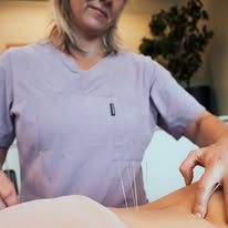 Kvinne i lilla arbeidsklær utfører akupunkturbehandling på en pasient med nåler i huden.