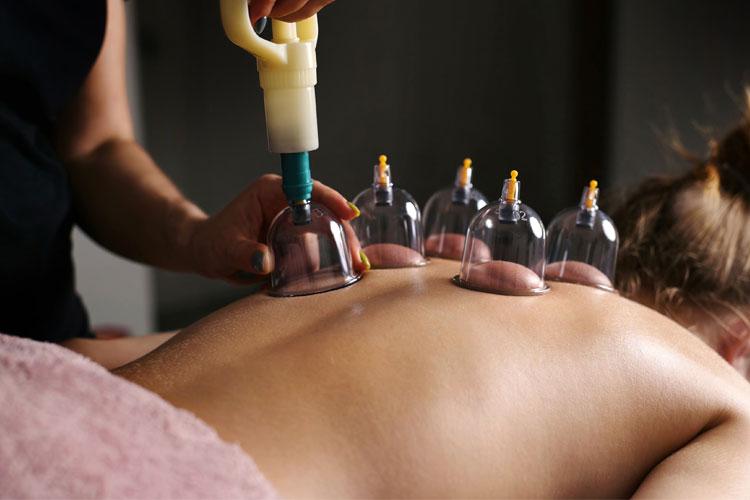 En person får behandling med cupping på ryggen, med flere glasskopper plassert på huden.