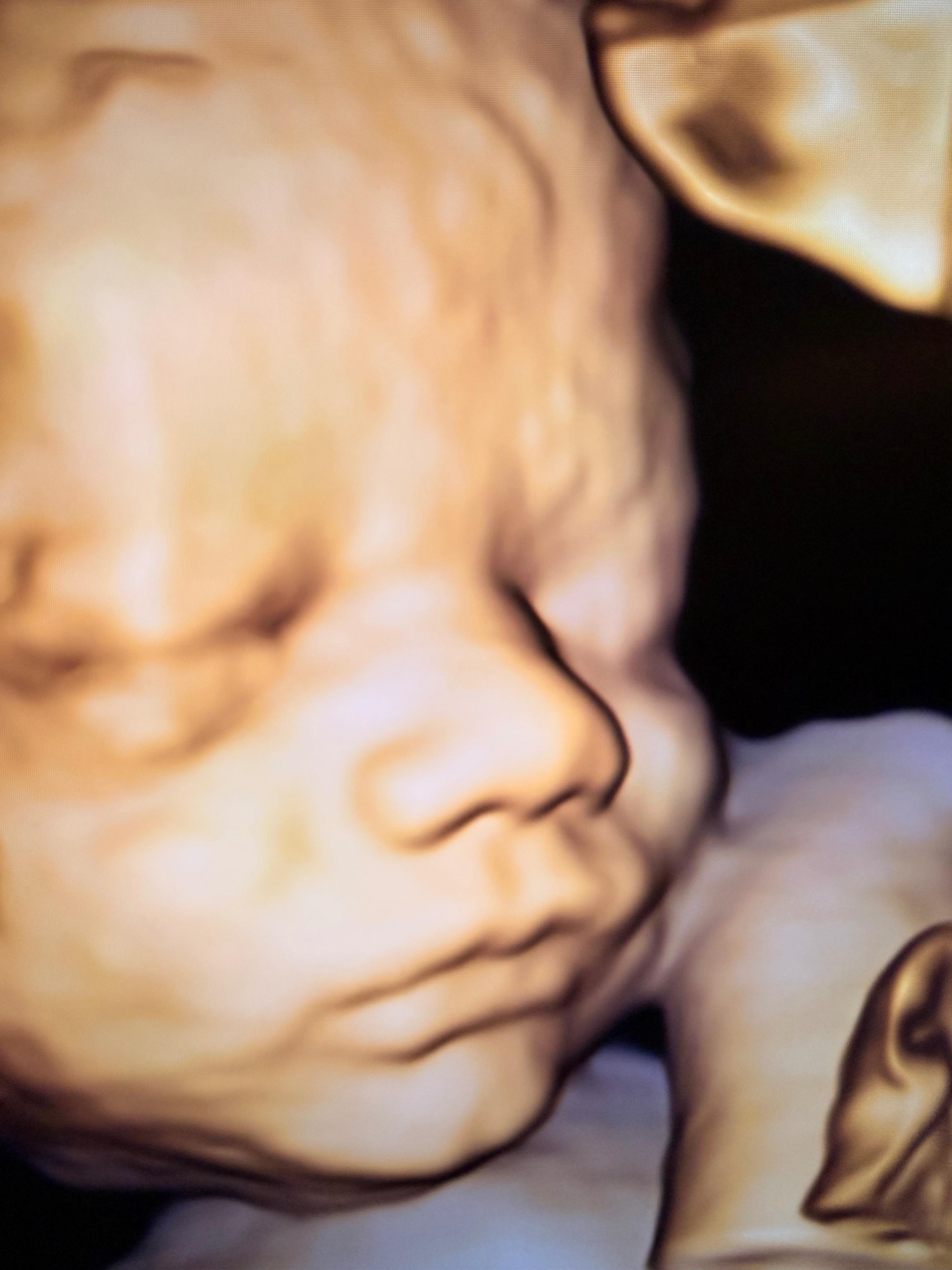 Ultralydbilde av en baby med lukket øye og avslappet ansiktsuttrykk.