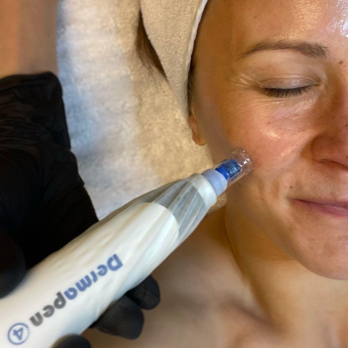 Kvinne får ansiktsbehandling med dermapen, som forbedrer hudens tekstur og utseende.
